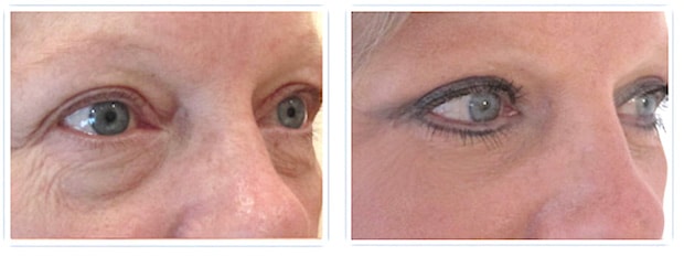 Résultat d'une chirurgie esthétique des paupières : blépharoplastie supérieure et inférieure permettant un rajeunissement et un regard naturel