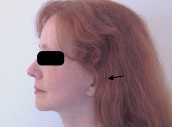 Lifting du visage et du cou à cicatrices courtes et fines