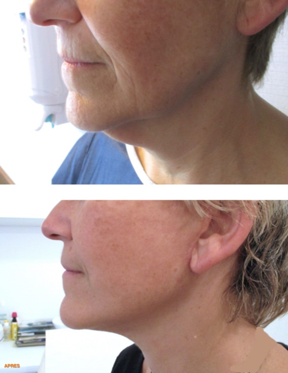 Résultat d'un lifting du bas du visage (cervico-jugal) traitant les joues, l'ovale (les bajoues) et le cou avec lipoaspiration du cou et des bajoues