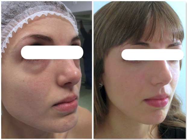 Correction des poches sous les yeux par blépharoplastie inférieure par voie conjonctivale (sans cicatrice)