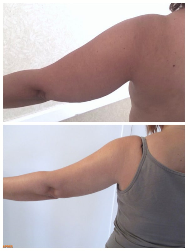 Résultat avant-après d'une chirurgie esthétique des bras par lipoaspiration