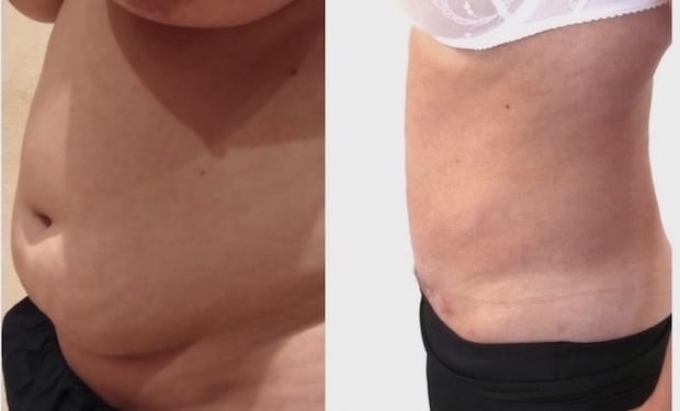 Résultat avant/après d'une chirurgie esthétique du ventre par plastie abdominale avec lipoaspiration