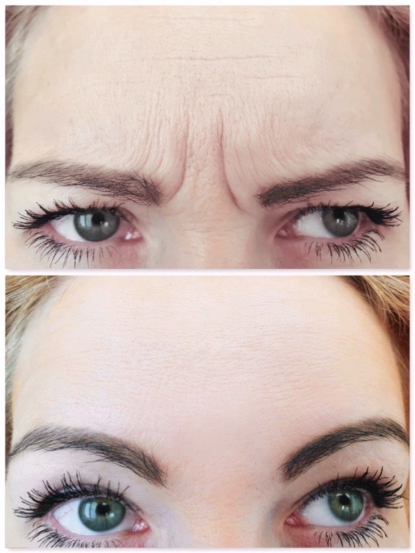 Rajeunissement par traitement des rides frontales et du lion chez une femme par injections de Botox©