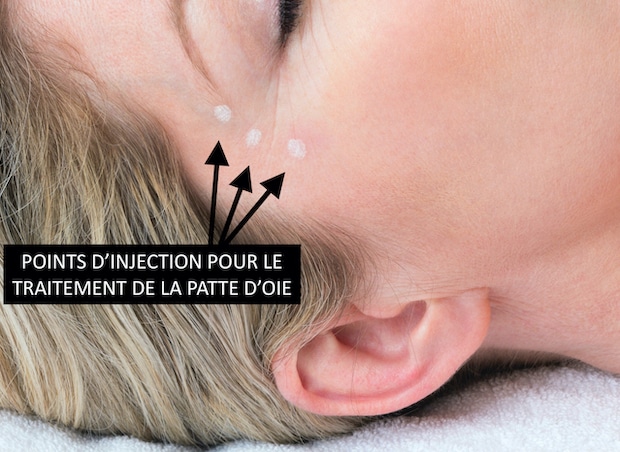Points d'injection du Botox permettant supprimer les rides de la patte d'oie