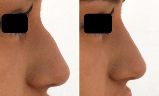 Résultats avant-après d'une rhinoplastie médicale par injection d'acide hyaluronique au niveau des dépressions du nez