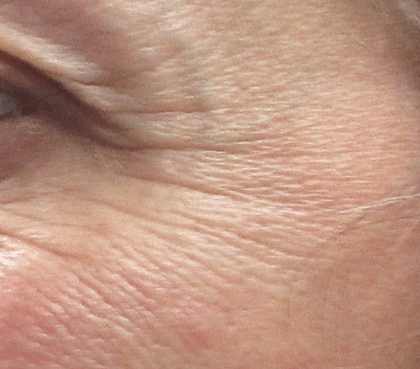 Rides de la patte d'oie pouvant être traitées par des injections de Botox©