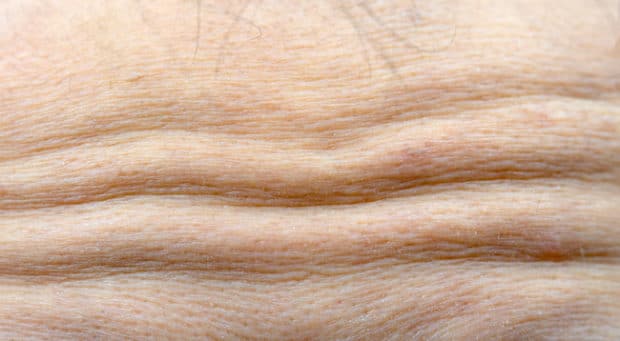 Rides du front pouvant être atténuées par les injections de Botox©