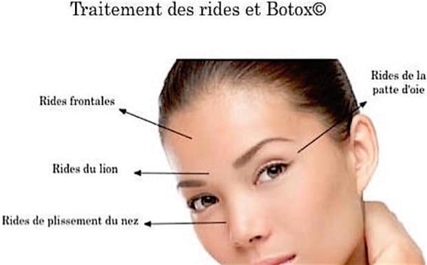 Traitement des rides avec le Botox