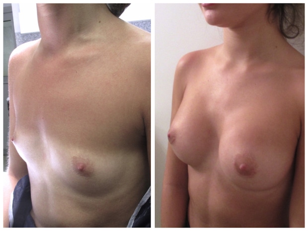Augmentation mammaire par implants de 260cc permettant de passer d'un bonnet A &agrave; un bonnet B