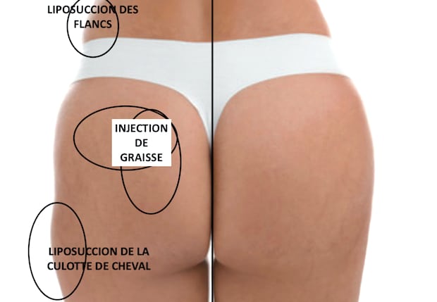 Zones lipofilling des fesses