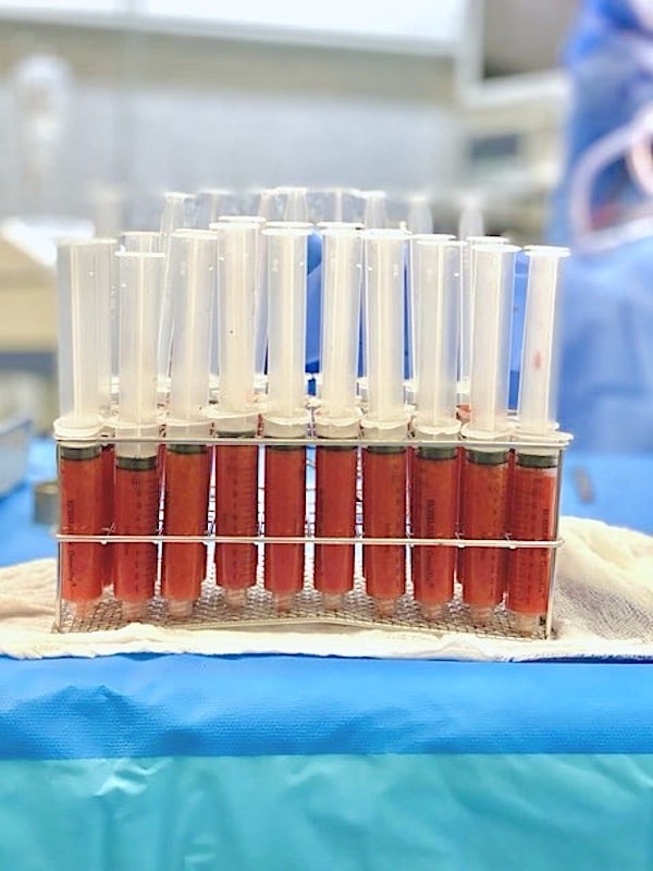 Après une lipoaspiration, la graisse est prête pour l'injection et l'augmentation du volume mammaire