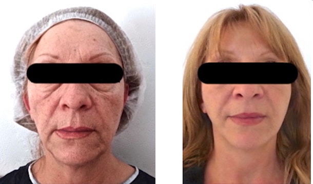 Injection de graisse au niveau du visage par lipofilling completant un lifting cervico-facial