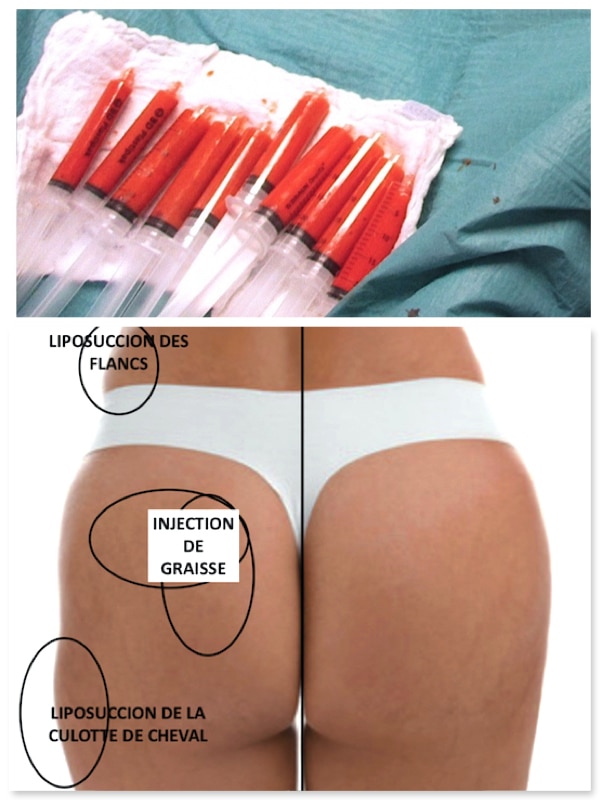 zones du lipofilling fessier