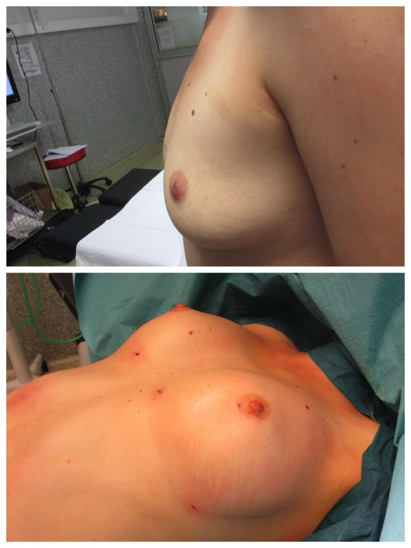 R&eacute;sultat d'un lipofilling mammaire par injection de graisse en fin d'intervention