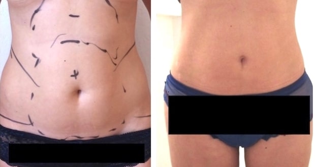 Résultat esthétique d'une lipoaspiration pour un prélèvement de graisse pour un lipofilling mammaire