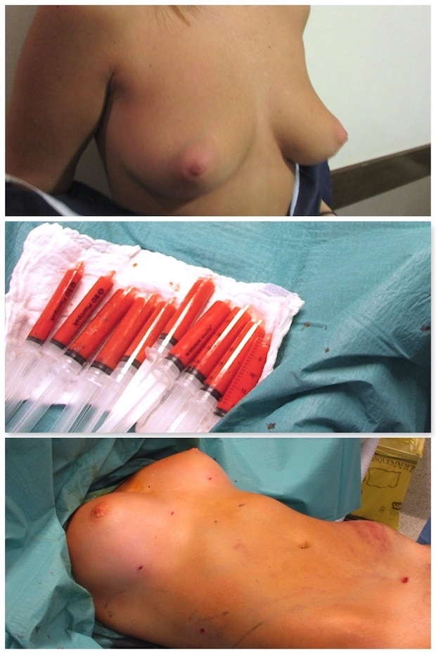 Exemple lipostructure: résultat d'une lipofilling mammaire par injection de graisse au niveau des seins