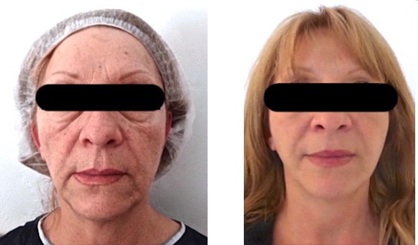 Résultat d'un lipofilling du visage associé à un lifting superficiel