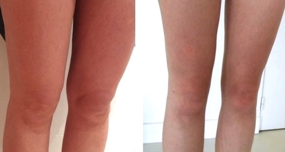 Zones fréquemment prélevées pour une injection de graisse par lipofilling du visage