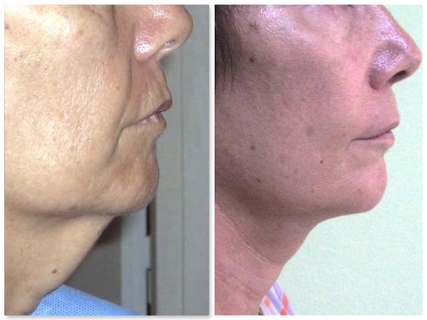 double menton exclusivement cutané traité par lifting cervical