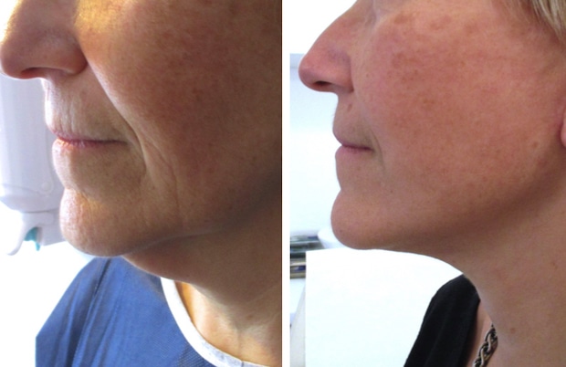 double menton traité par lifting et liposuccion cou