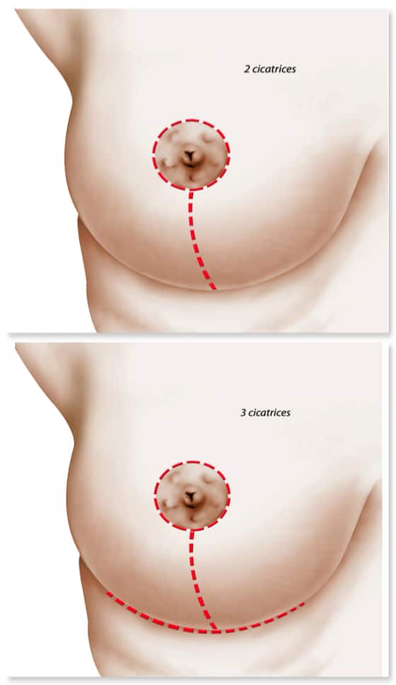 Le 2 types de cicatrice selon l'importance de la réduction mammaire: cicatrice verticale et en "T inversé"
