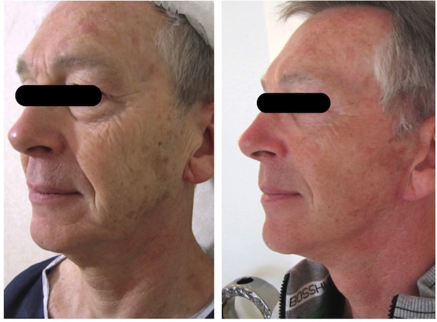 Lifting du visage et blepharoplastie supérieure et inférieure chez un homme