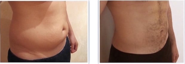 Résultat d'un traitement de la “bouée” chez un homme par liposuccion du ventre et des poignées d'amour (flancs)