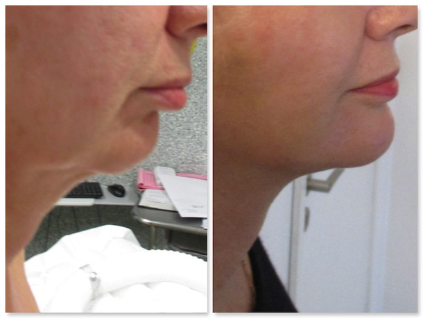 Résultat d'un lifting du bas du visage (mini-lifting localisé) qui a permis de traiter l'ovale