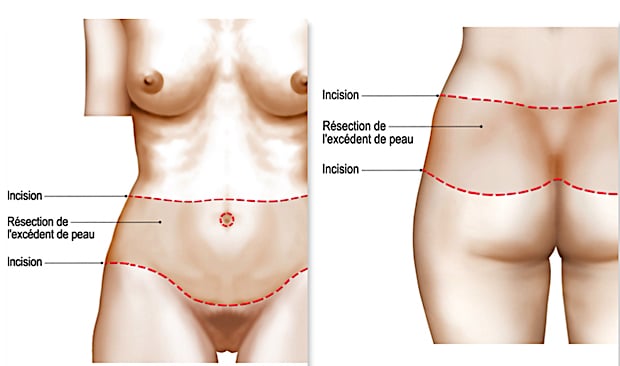 Principe de la dermolipectomie circulaire inférieure : bodylift classique