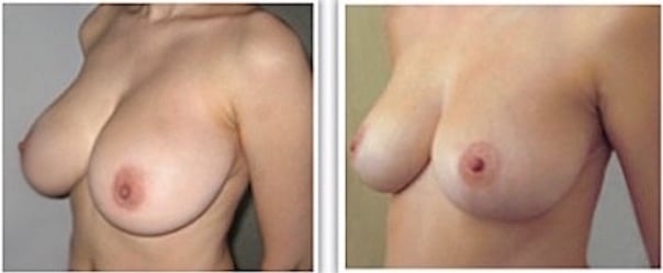 Réduction mammaire après une grossesse et un allaitement (passage d'un bonnet E à un bonnet C)
