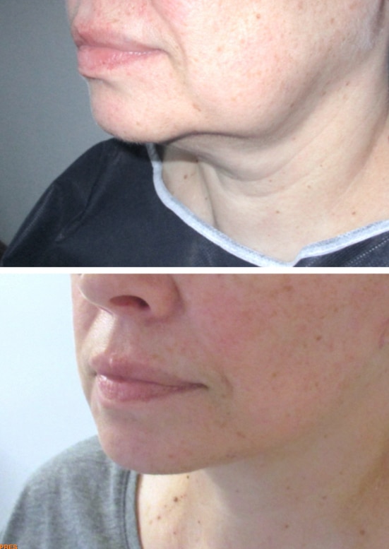 Résultat d'un mini-lifting du visage traitant l'ovale : cou, bajoues et rides d'amertumes.