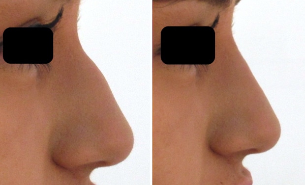Résultat d'une rhinoplastie médicale : la correction de la bosse s'est faite sans chirurgie grâce à l'injection d'acide hyaluronique