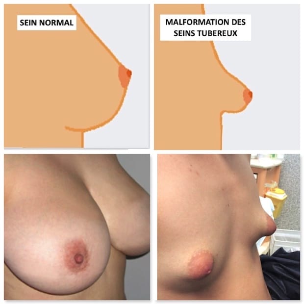 sein normal et sein tubéreux