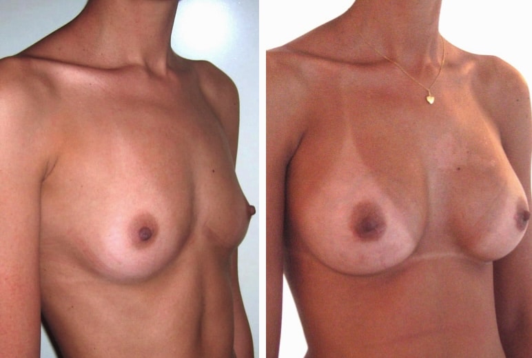 cicatrice implant mammaire au 5e mois