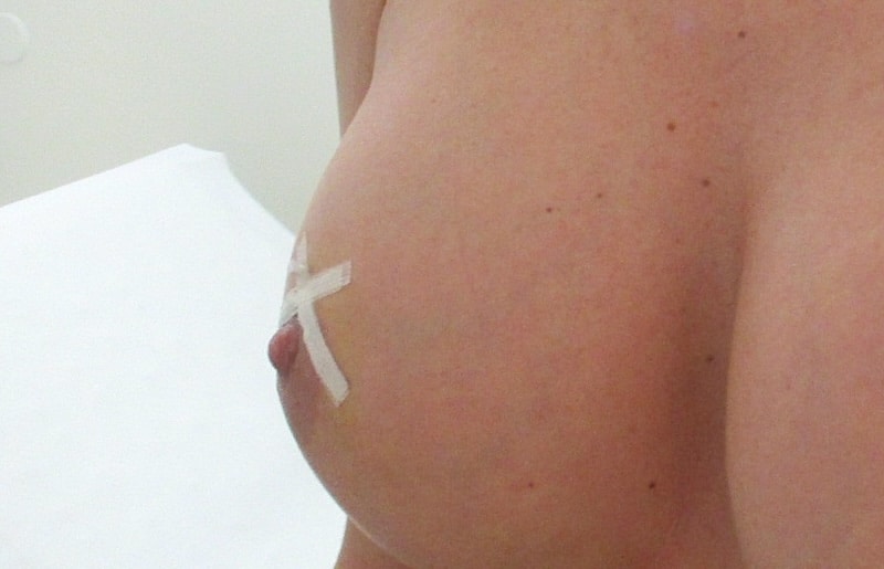 st&eacute;ristrips cicatrice augmentation mammaire par implant