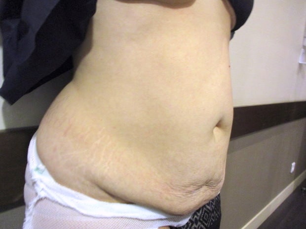 Diastasis des muscles grands droits avec tablier abdominal