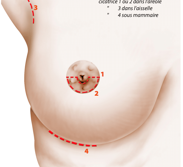 Les cicatrices possibles pour une augmentation mammaire par implants
