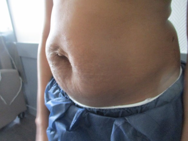 Diastasis avec hernie ombilicale faisant suite à une grossesse (accouchement il ya 10 mois)