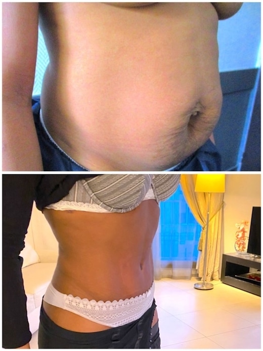 Résultat d'un traitement de diastasis et de hernie ombilicale après grossesse par abdominoplastie