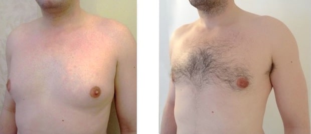 Résultat d'une operation de gynecomastie par liposuccion et retrait du noyau glandulaire