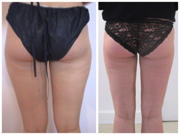 Lipoaspiration circulaire traitant un lipoedème des cuisses et des genoux
