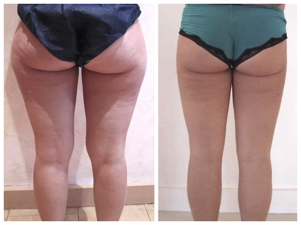 Lipoedème des cuisses (de la culotte de cheval) et des genoux traité par liposuccion circulaire