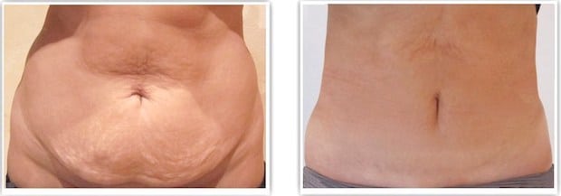 mini-abdominoplastie + liposuccion du ventre et de la taille