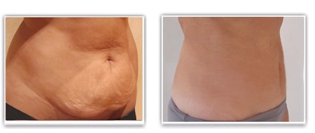 mini-lifting abdominal