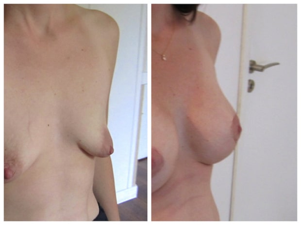 Correction de ptose mammaire avec augmentation du volume de la poitrine par implants