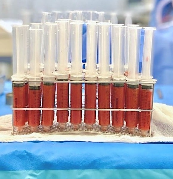Seringues de graisse centrifugée prêtes pour un lipofilling mammaire