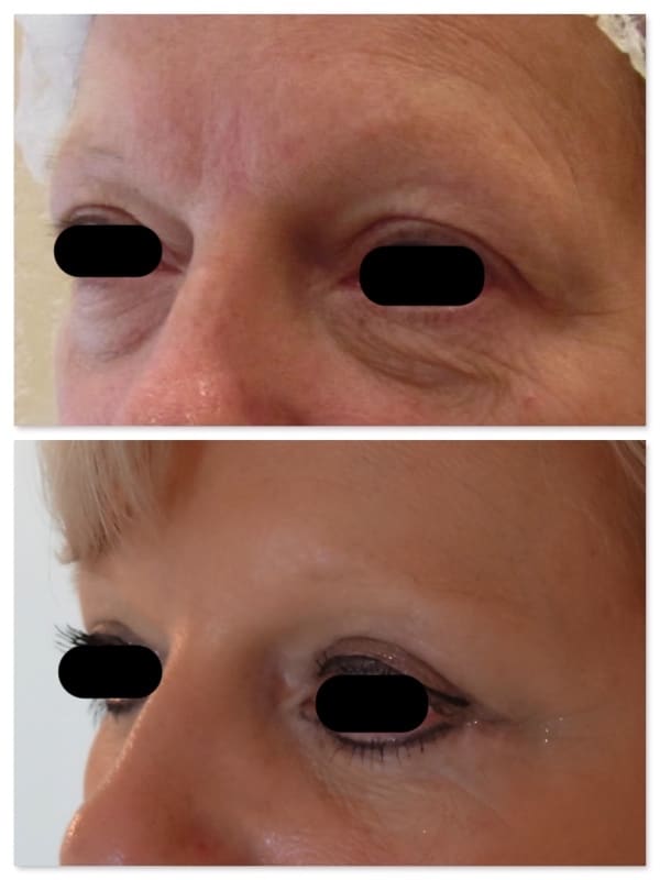 Blépharoplastie des paupières supérieures et inférieures avec Botox© (toxine botulique)