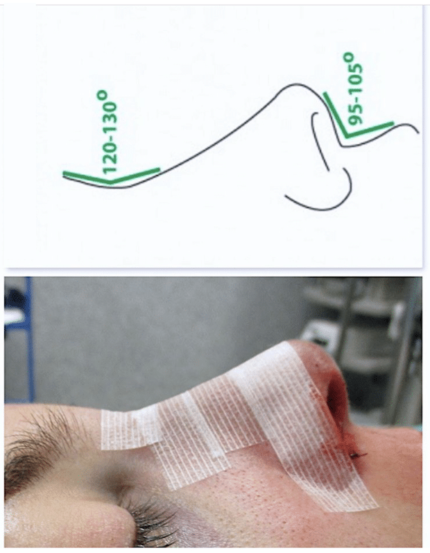 Toute correction du nez doit se faire sans aucune hyper-correction pour un résultat naturel