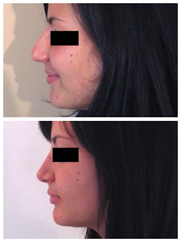 Résultat d'une rhinoplastie esthétique corrigeant la bosse et la pointe du nez