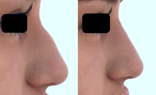 Rhinoplastie médicale sans opération par injection d'acide hyaluronique